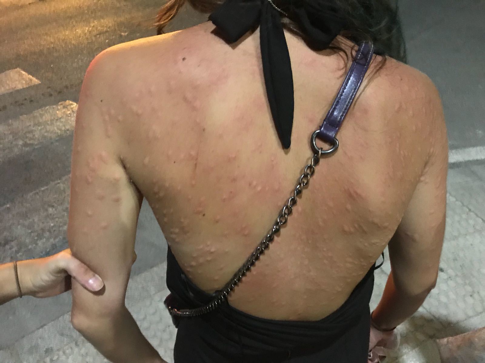 Una joven, anoche, atacada por mosquitos en bajo de Guía.