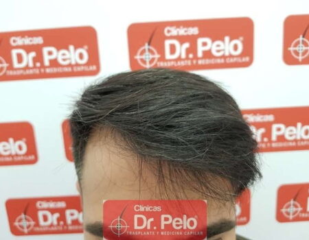 Dr Pelo: referencia en injerto capilar Sevilla